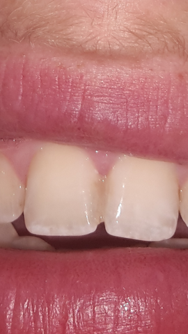 Kunststoff Zwischen Zahnlucke Zahne Kieferorthopade Kunststoff Zwischen Zahnlucke Zahne Kieferorthopade