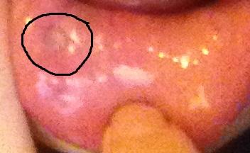 Labretpiercing Stud Zu Kurz Platte Druckt Sich Stark Ein Einwachsen Medizin Piercing Lippe