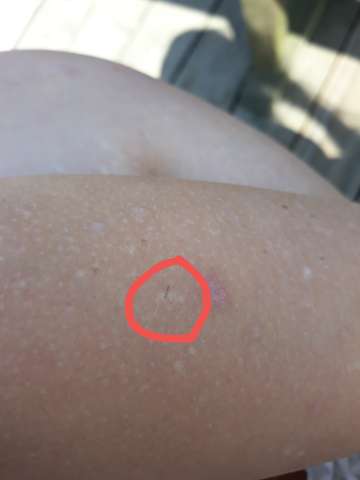 Langlicher Leber Fleck Ist Das Normal Hautprobleme Leberfleck Langlicher Leber Fleck Ist Das Normal Hautprobleme Leberfleck