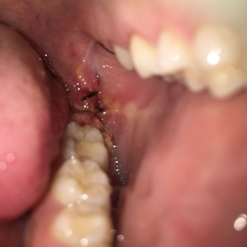 Hinten am letzten Zahn sind gelbe Klümpchen  - (Schmerzen, Operation, Weisheitszähne)