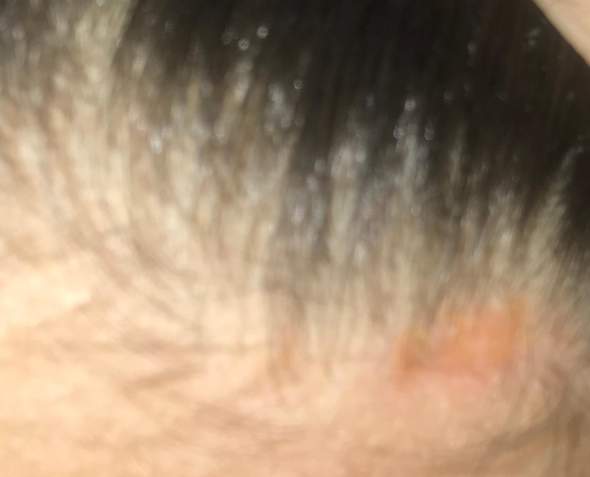 schuppen nissen gesundheit haare