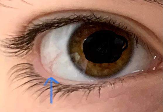 lange geplatzte ader im auge ein grund zur sorge? (Gesundheit und