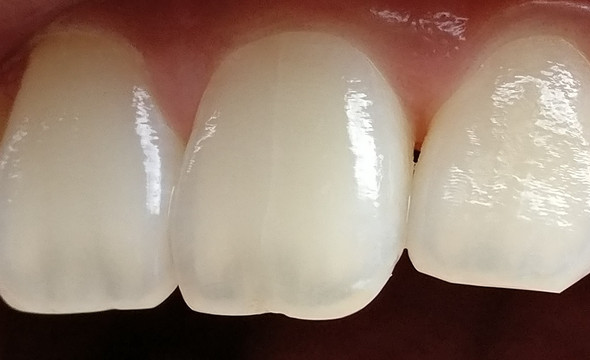 Langer Riss Im Schneidezahn Schmerzen Zahne Zahnarzt