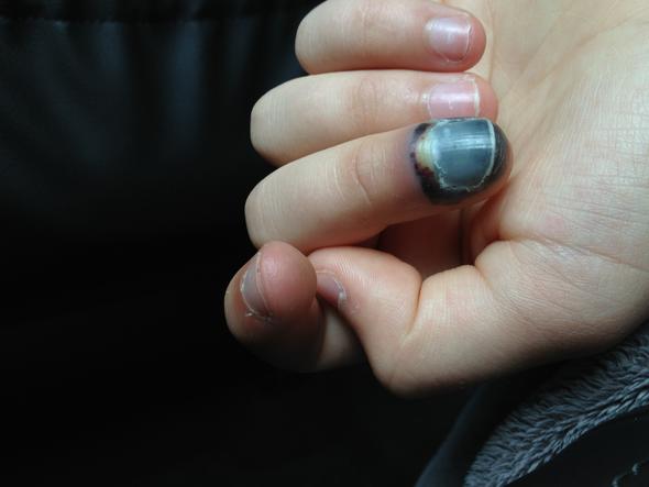 Langsam Schwarzer Geschwollener Finger Arzt Entzundung Doktor Langsam Schwarzer Geschwollener Finger Arzt Entzundung Doktor