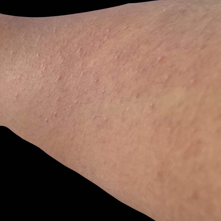 pickel auf arm pickel auf arm