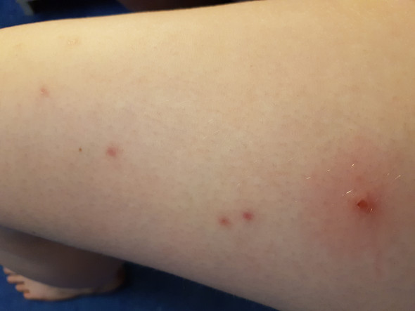 Lauter Rote Stichartige Pickel auf den Beinen. Was ist es? (Gesundheit und Medizin, Tattoo pickel auf beinen