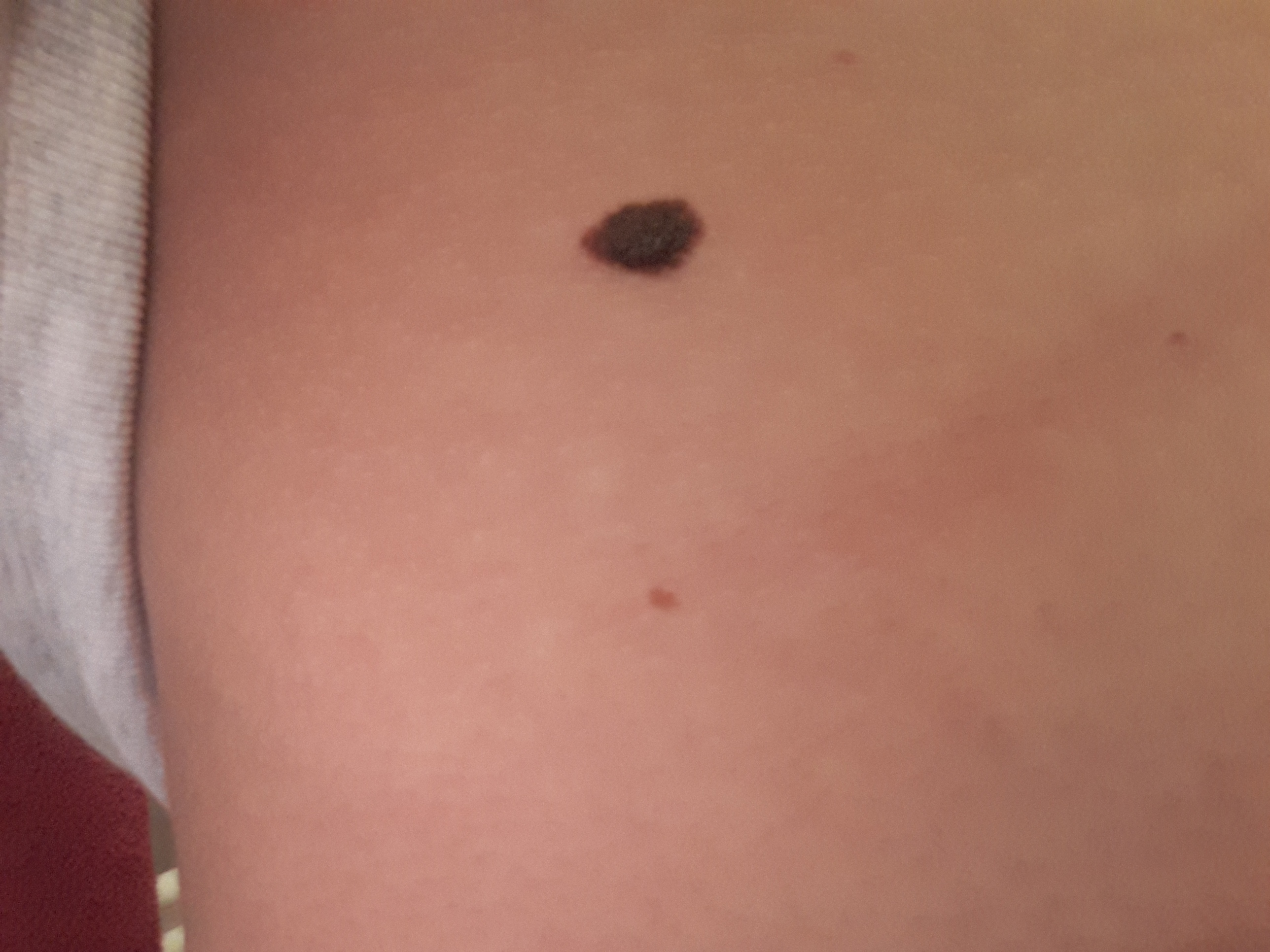 Leberfleck 1 Cm Gefahrlich Tumor Leberfleck 1 Cm Gefahrlich Tumor