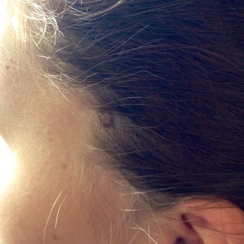 leberfleck am kopf entfernen lassen