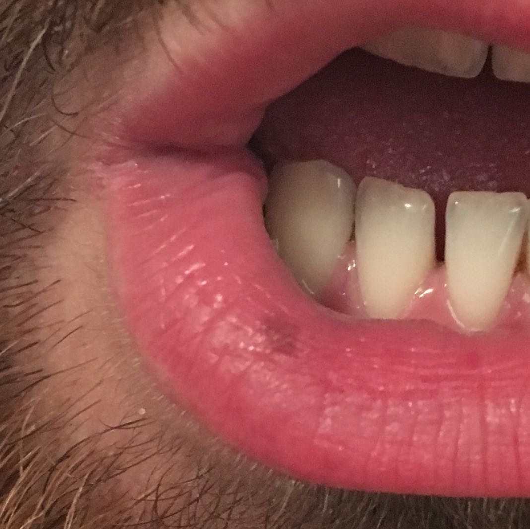 Leberfleck Auf Unterlippe Flecken Lippe Hautkrebs Leberfleck Auf Unterlippe Flecken Lippe Hautkrebs