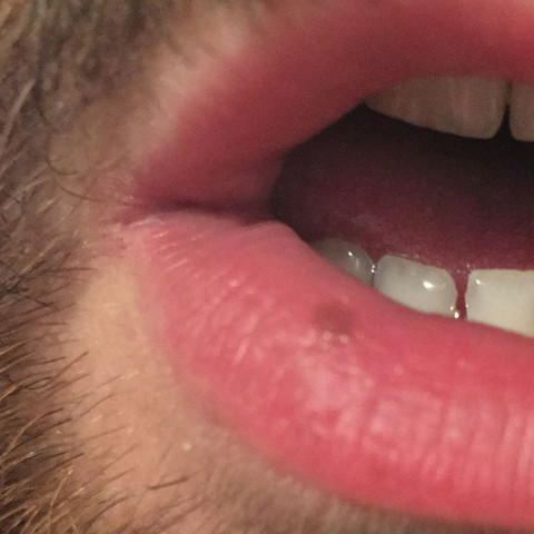 Leberfleck Auf Unterlippe Flecken Lippe Hautkrebs Leberfleck Auf Unterlippe Flecken Lippe Hautkrebs