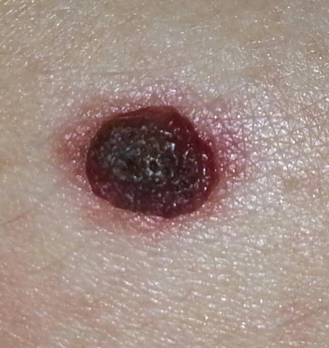 Wie die Pigmentation auf der Person für immer zu entfernen