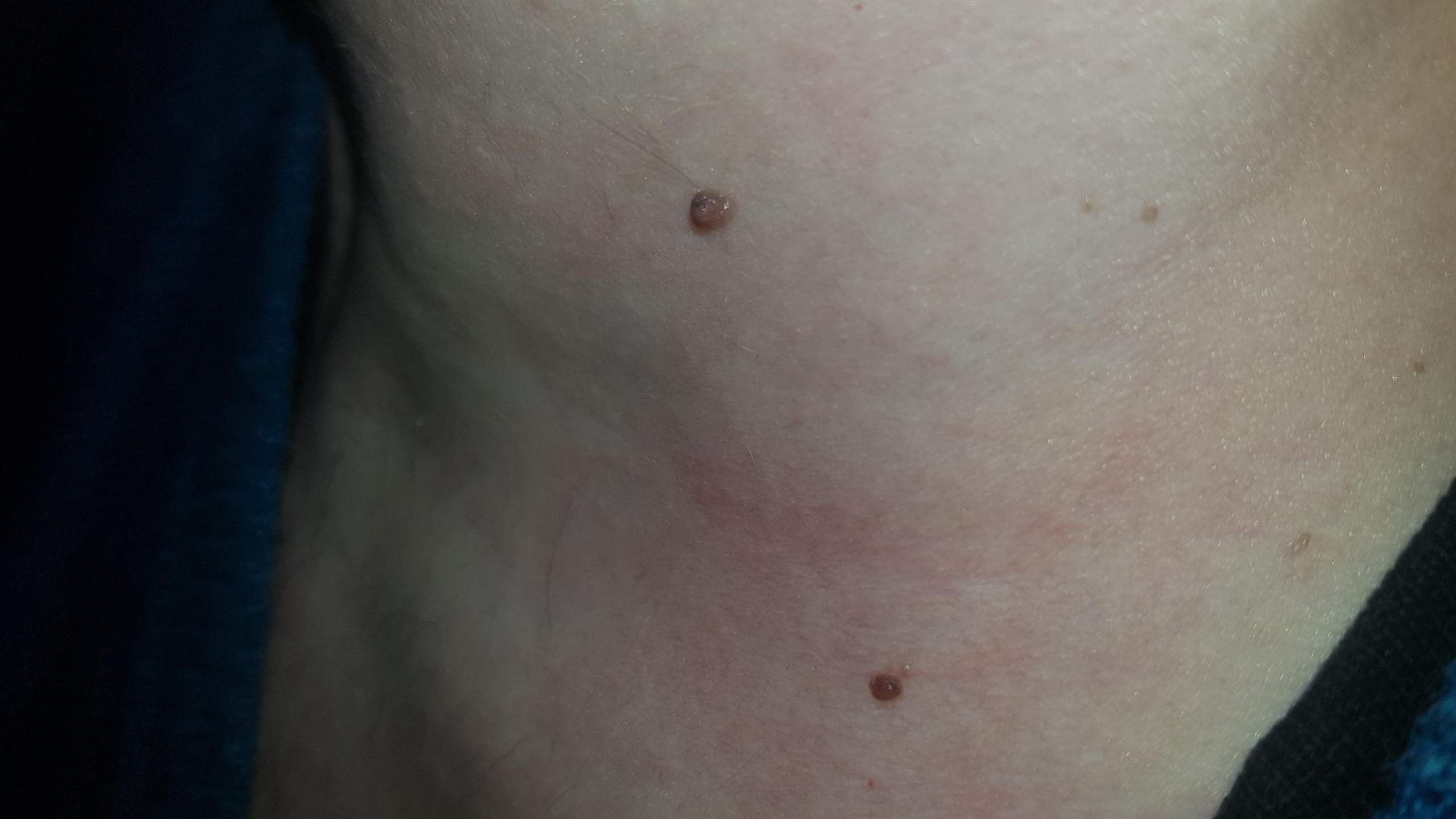 Leberflecke abchecken lassen? (Gesundheit und Medizin, Leberfleck)