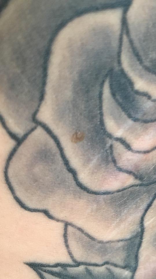 Leberfleck/Hautkrebs durch Tattoo? (Gesundheit, Gesundheit und Medizin