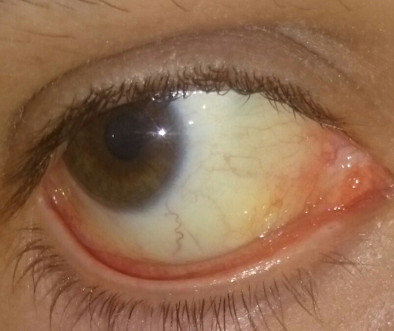 Leicht Gelbliche Augen Gesundheit Medizin Leber Leicht Gelbliche Augen Gesundheit Medizin Leber