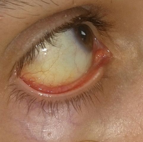 Leicht Gelbliche Augen Gesundheit Medizin Leber Leicht Gelbliche Augen Gesundheit Medizin Leber