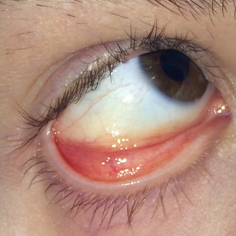 Leicht Gelblicher Augapfel Gesundheit Medizin Augen Leicht Gelblicher Augapfel Gesundheit Medizin Augen