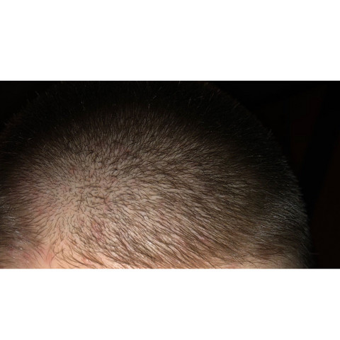 Leicht Kahle Stelle Auf Dem Kopf Woran Liegt Das Und Was Genau Ist Das Haare Beauty Frisur Leicht Kahle Stelle Auf Dem Kopf Woran Liegt Das Und Was Genau Ist Das Haare Beauty Frisur