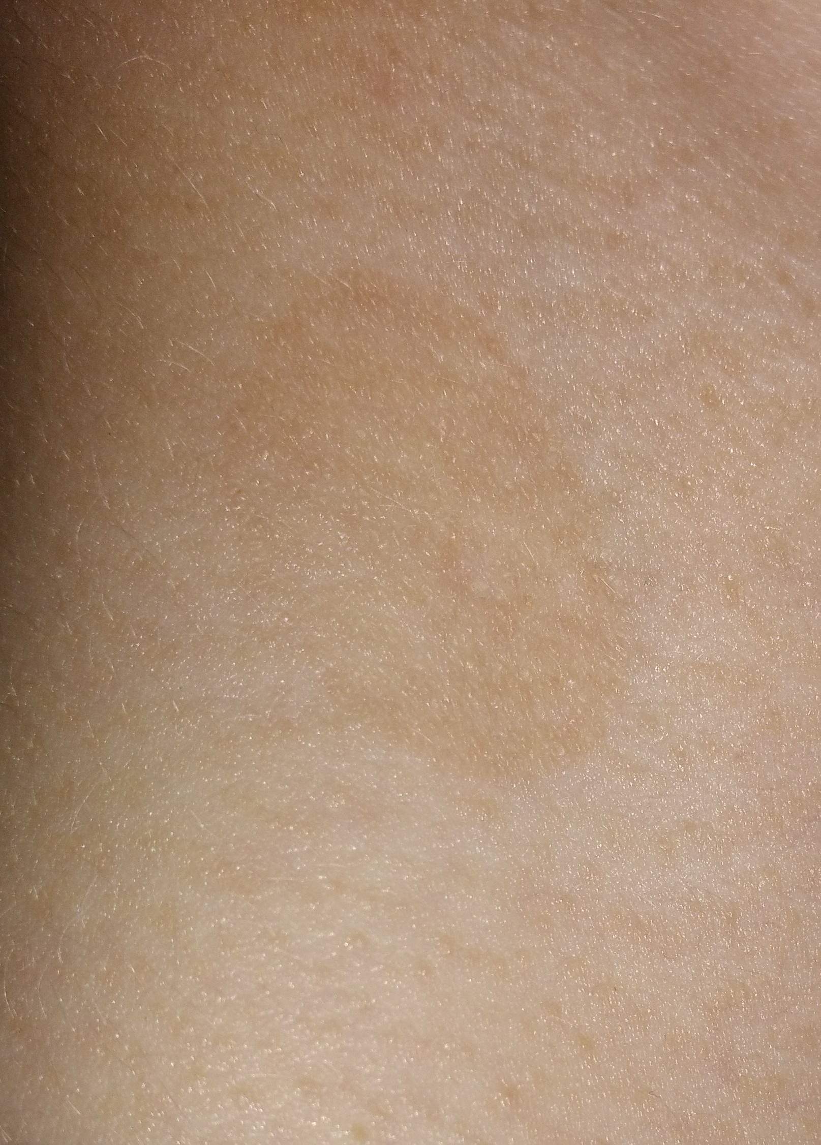 Leichte Braune Flecken auf der Haut? (Gesundheit, Hautarzt)