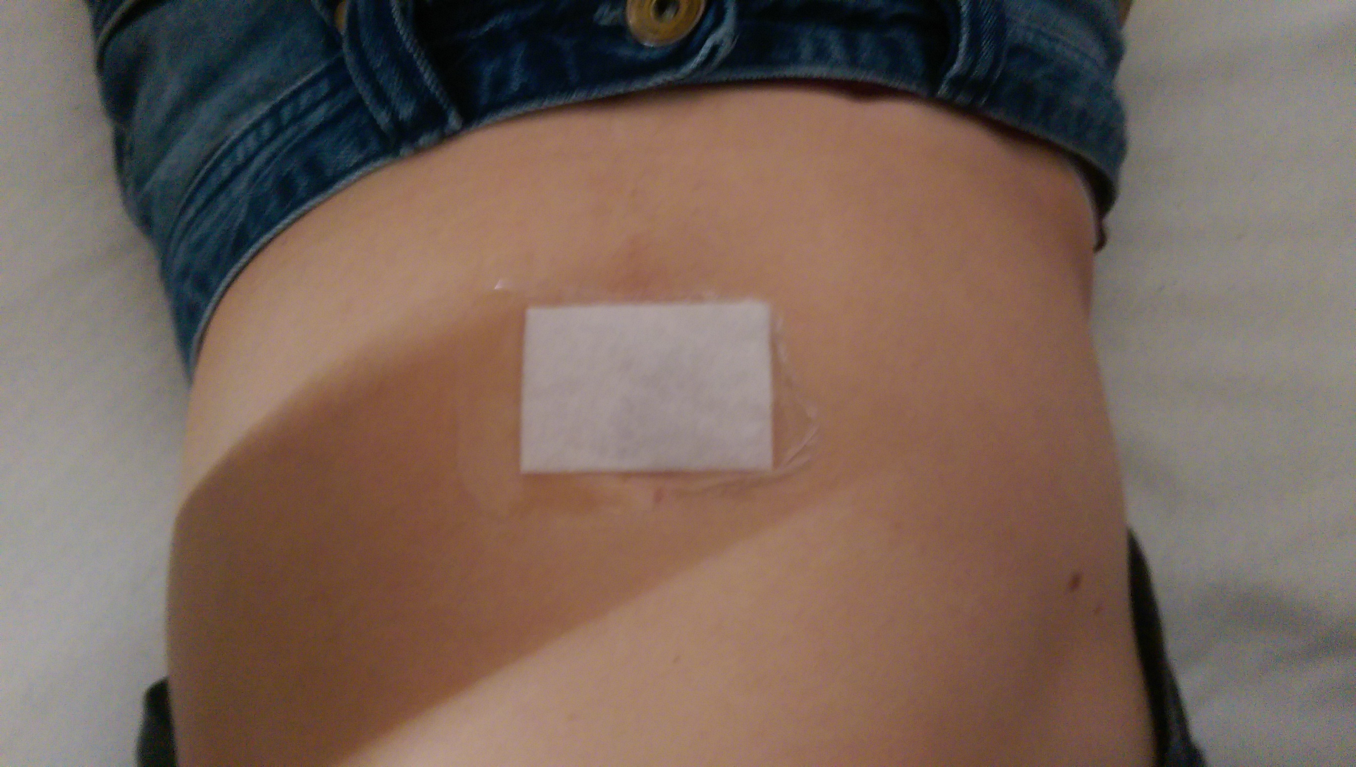 Leichte Schmerzen nach Nabelbruch OP? Leichte Schmerzen nach Nabelbruch OP?