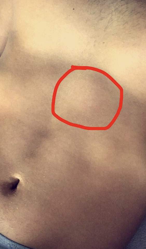 Leichte Schwellung Kurz Unter Der Rechten Brust Seite An Der Rippe Gesundheit Ziehen Leichte Schwellung Kurz Unter Der Rechten Brust Seite An Der Rippe Gesundheit Ziehen