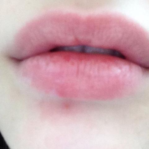 Leichter Lymphknoten Unterm Kinn Was Tun Leicht Leichter Lymphknoten Unterm Kinn Was Tun Leicht