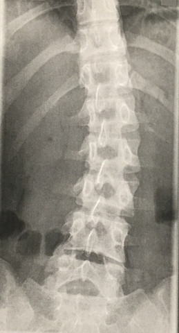Röntgenbild - (Rückenschmerzen, Orthopäde, Wirbelsäule)