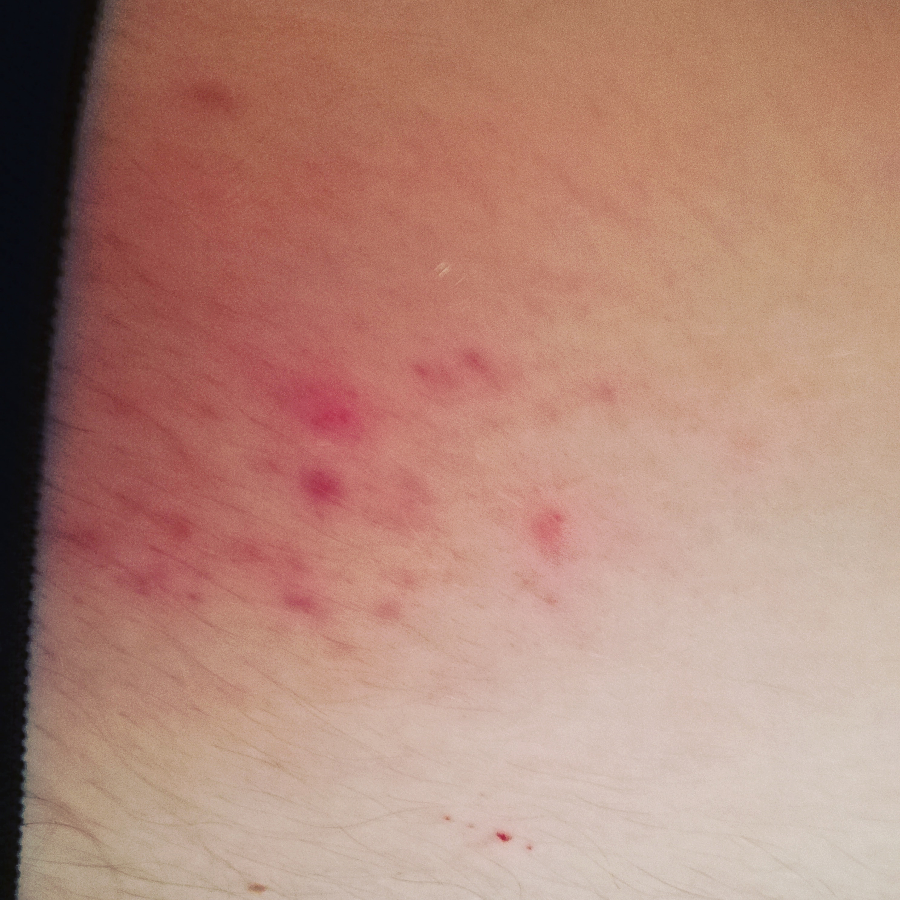 Leukämie mit 18 , haben Angst.? (Gesundheit, Krankheit, Krebs)