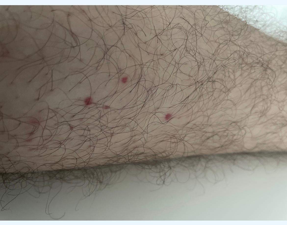 Leukozytoklastische Vaskulitis schlimm? (Gesundheit und Medizin, Arzt ...