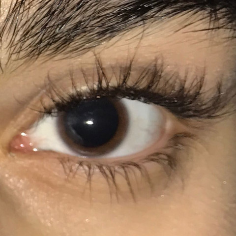 Die Pupille ist richtig riesig und das die ganze Zeit...  - (Augen, Augenarzt)