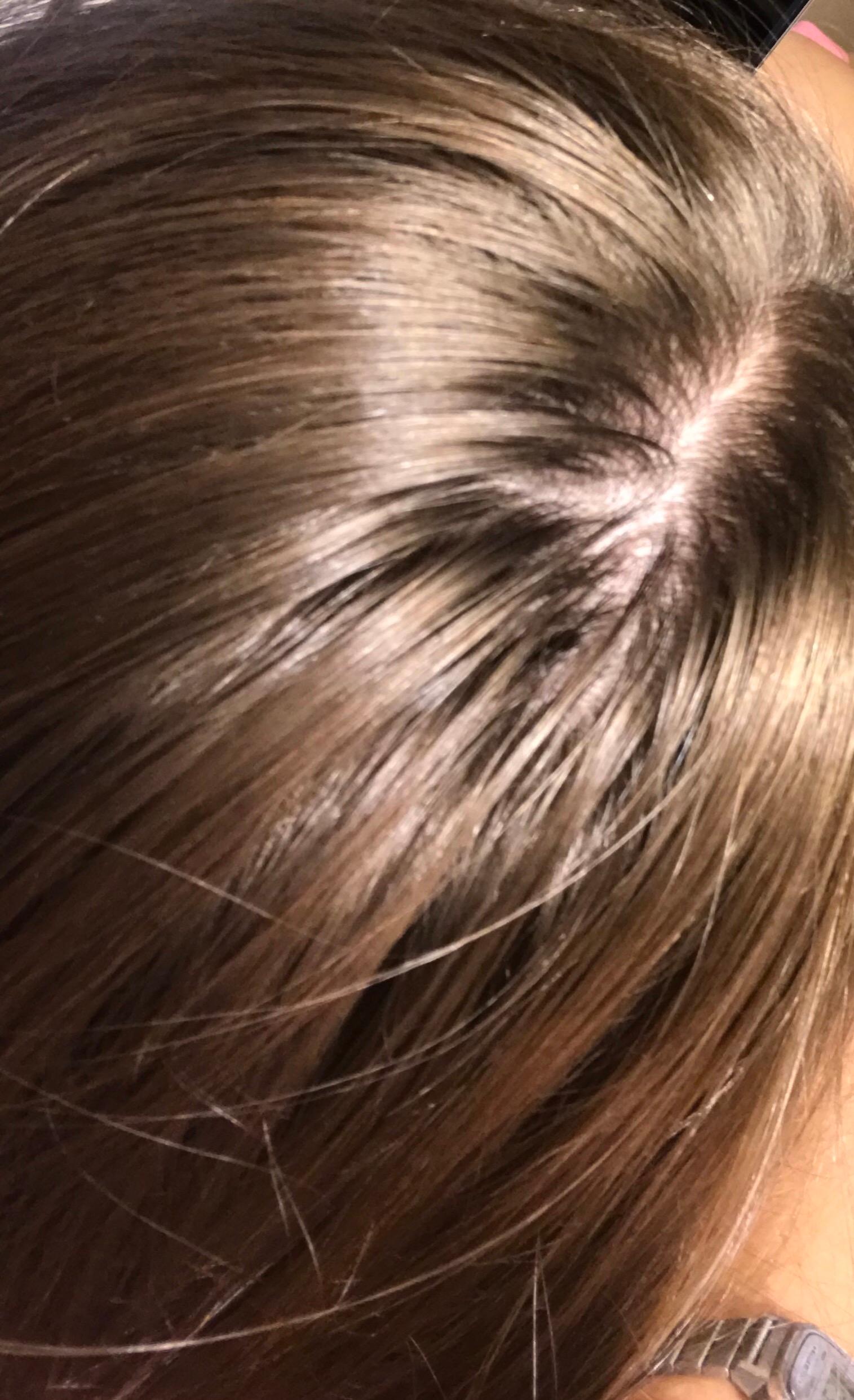 lichte haare hinten ausfall