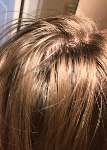 lichte haare hinten ausfall