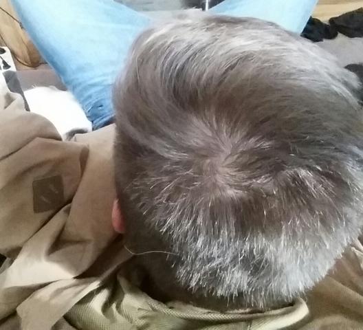 Bild lalalalal - (Haare, Haarausfall)