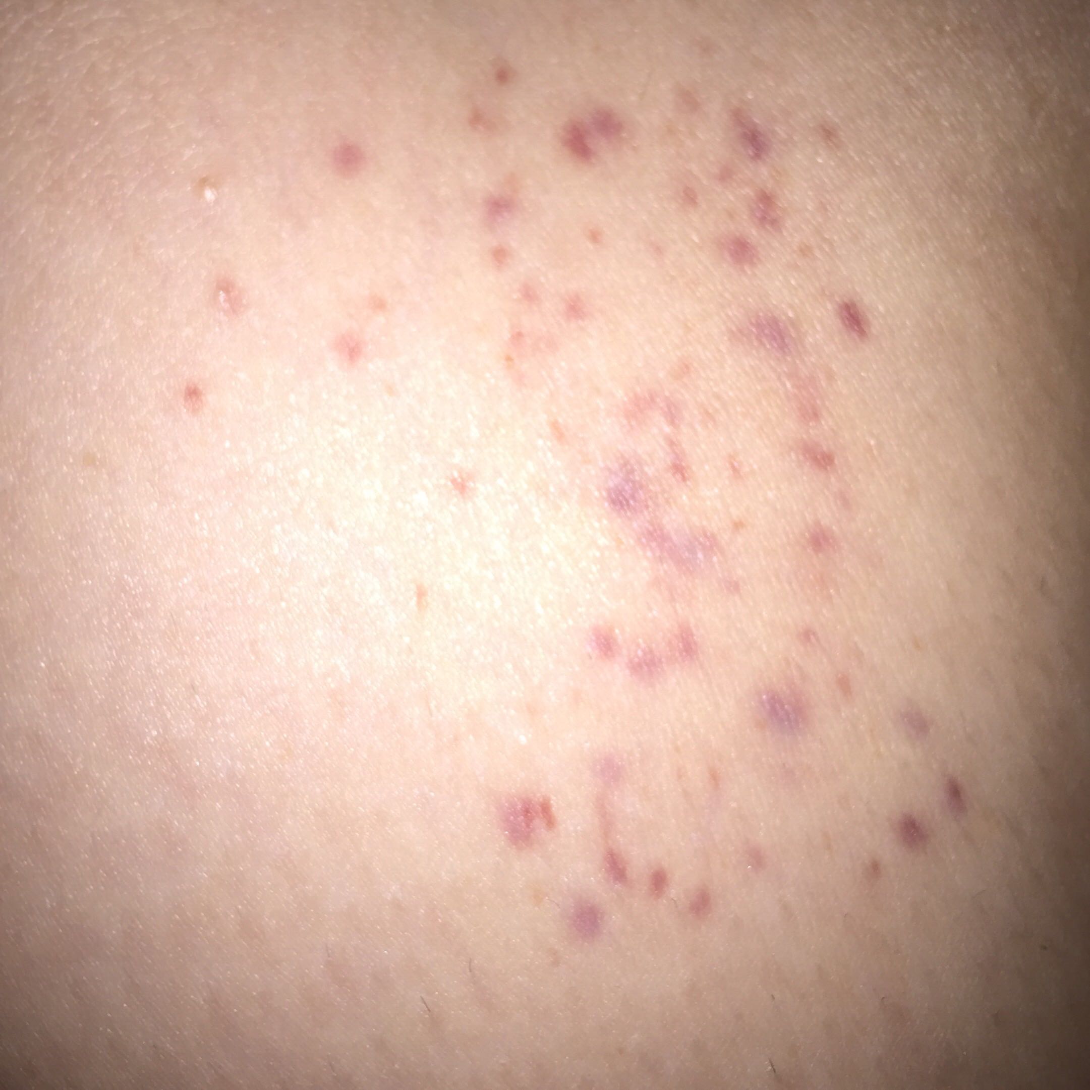 Kleine Lila Flecken Auf Der Haut