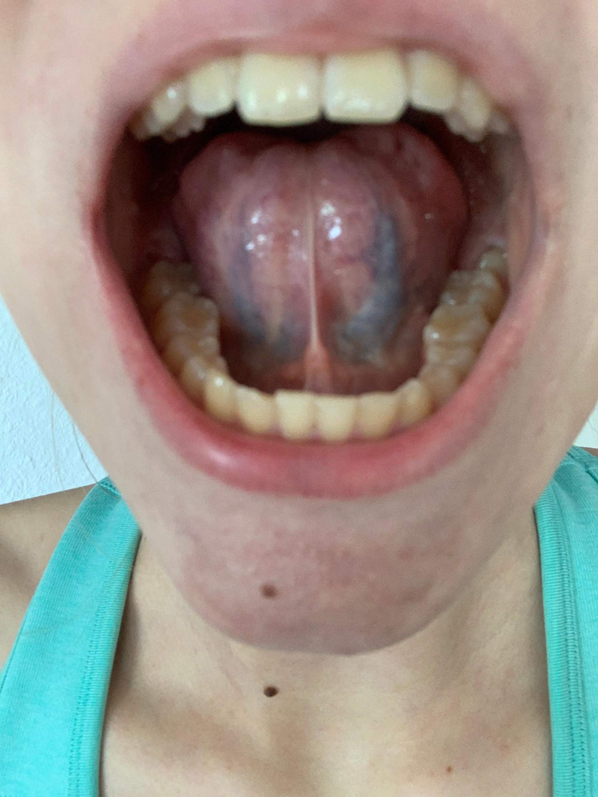lila unten an der Zunge? (Gesundheit und Medizin)