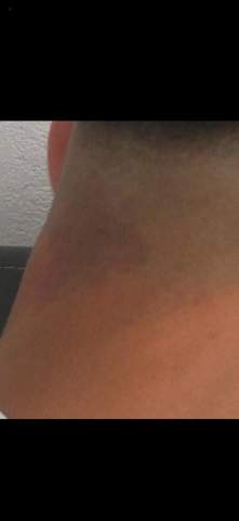 Lila Rote Flecken Am Kopf Immer Nach Dem Haare Schneiden Hautausschlag