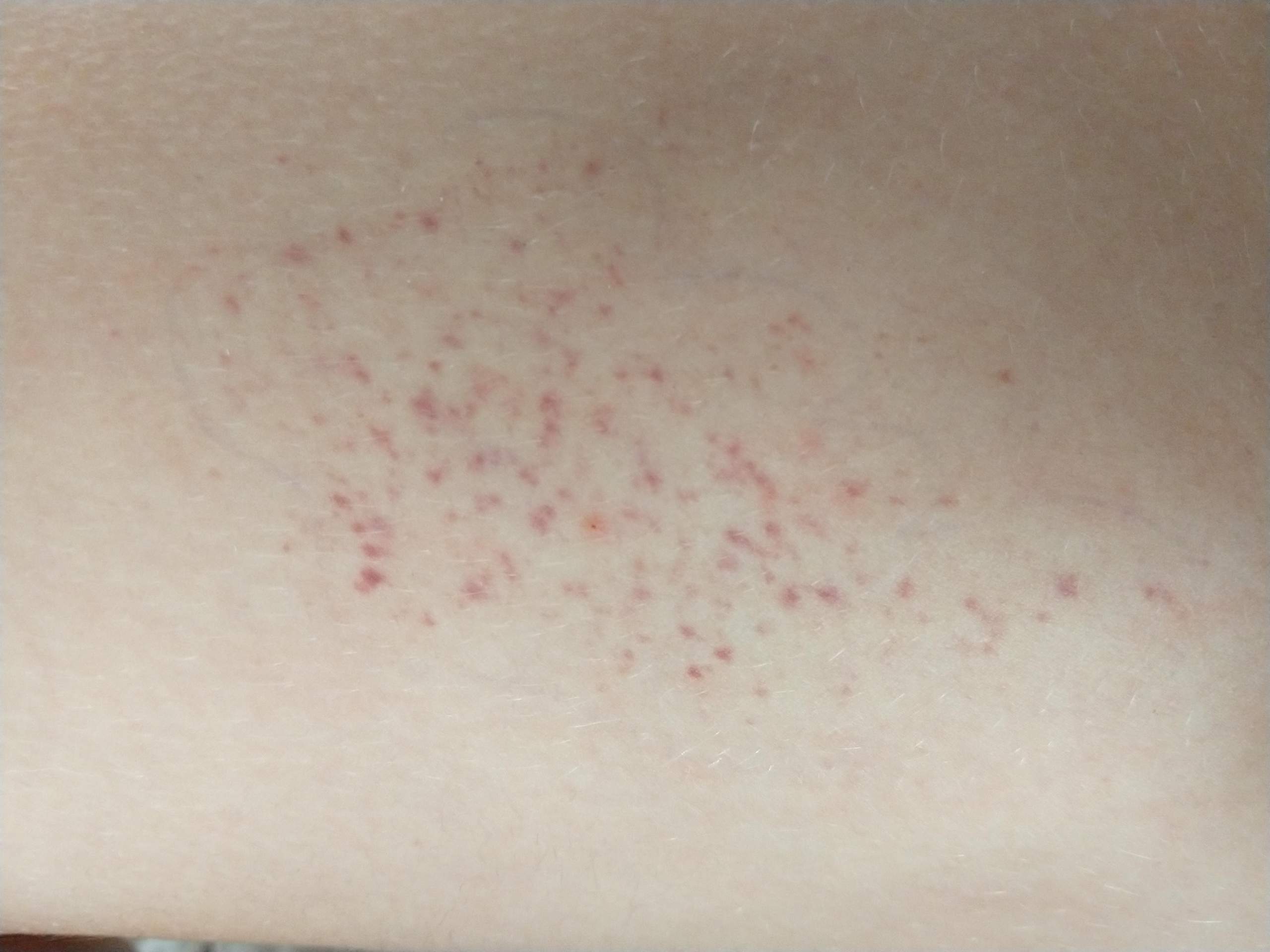Lila/Rote Punktr auf dem oberschenkel? (Gesundheit und Medizin, Haut)