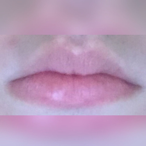 Die Linke Untere Lippe ist geößer😩 - (Operation, Lippe, Unten)