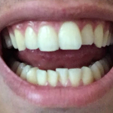 Zähne richten lassen schiefe Schiefe Zähne