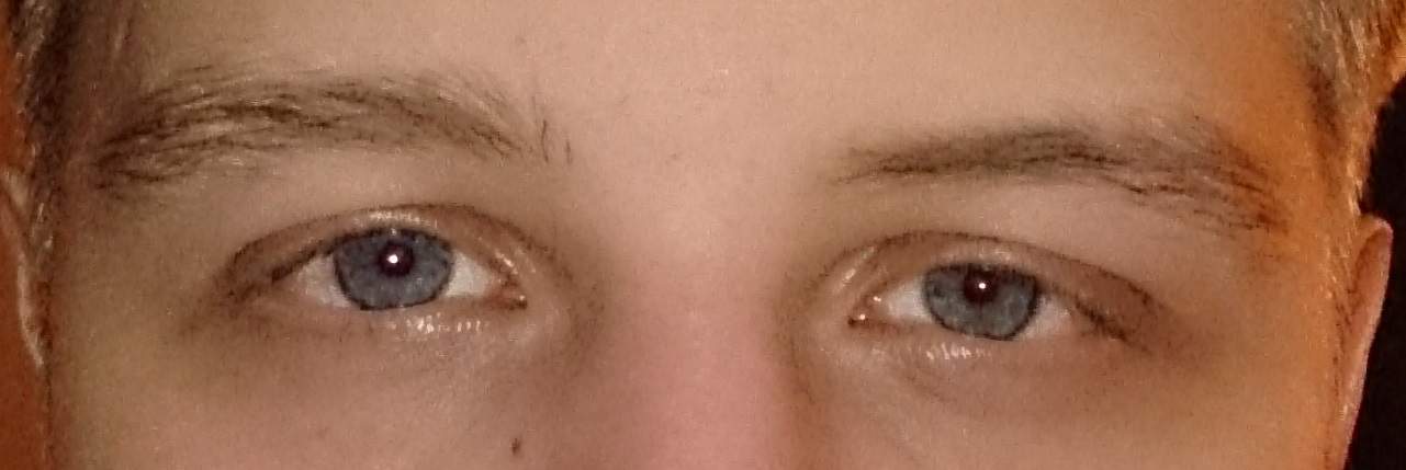 Warum ist mein linkes Auge (Augenlid) geschwollen ? (Augen, Augenarzt)