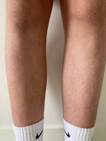 Lipödem oder dicke Beine?