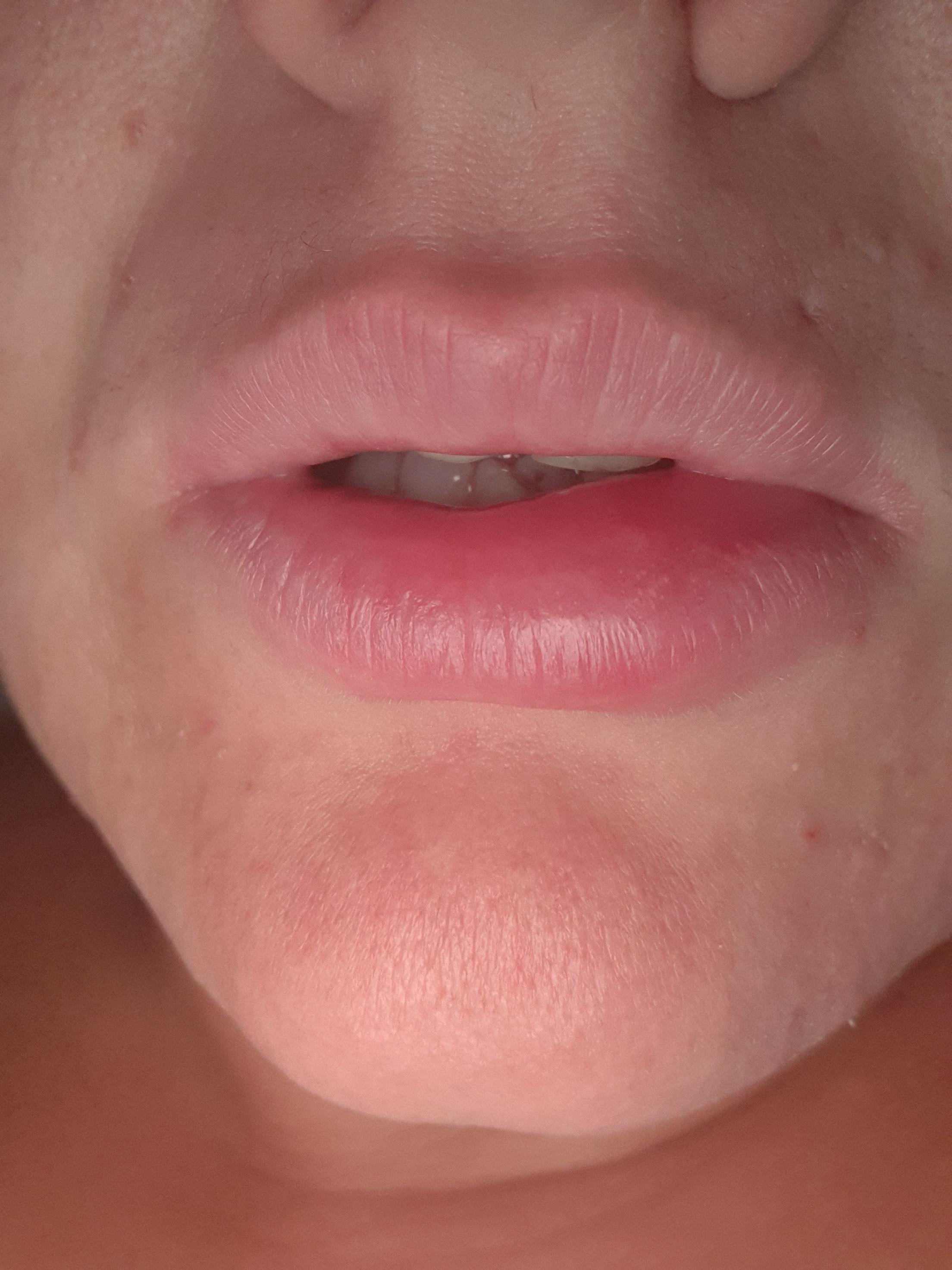 Lippe? (Gesundheit und Medizin, Gesundheit, lippenpflege)