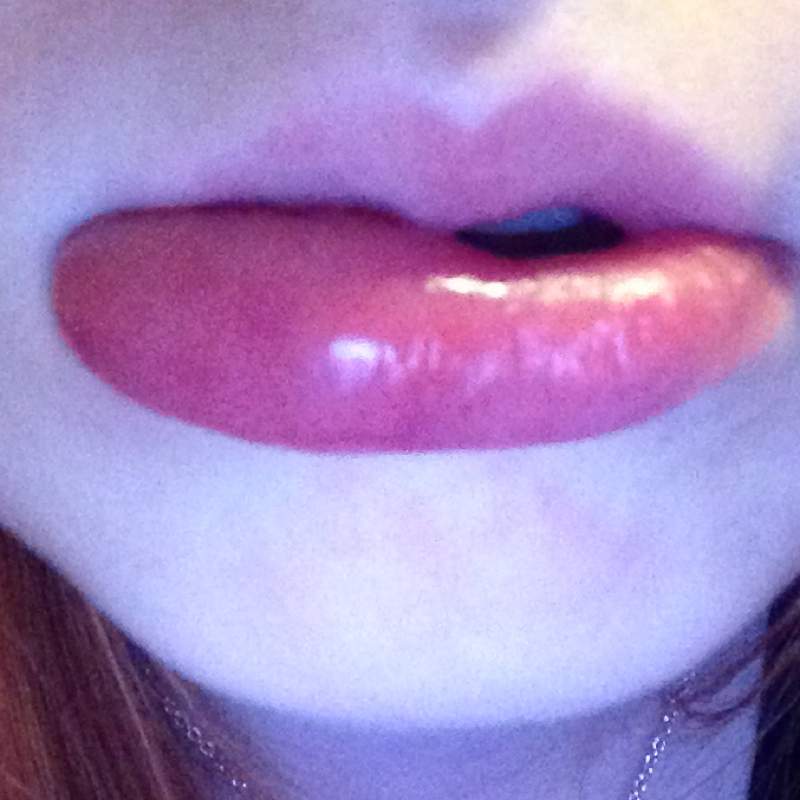 Geschwollen lippe gebissen Lippe angeschwollen