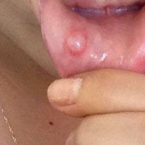 Lippe Blaschen Mund Blaeschen Lippe Blaschen Mund Blaeschen