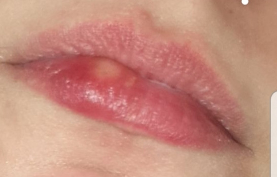 Gebissen geschwollen lippe Lippe geschwollen?