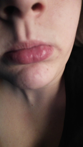 Lippe Geschwollen Und Komische Blase Gesundheit Lippe Geschwollen Und Komische Blase Gesundheit