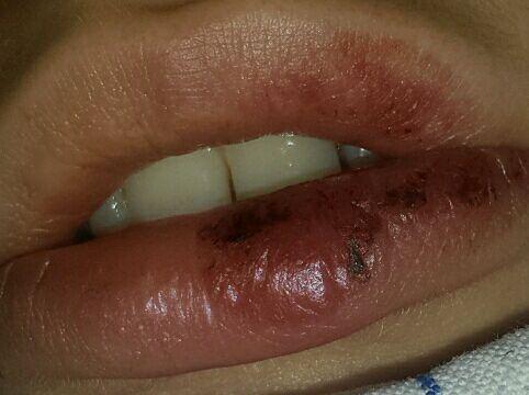Lippe Heilung Blutkruste