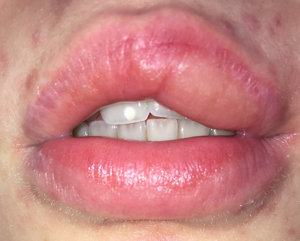 Lippe Plotzlich Extrem Dick Gesundheit Und Medizin Medizin Kosmetik