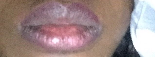 - (Wunde, Lippe, Heilung)