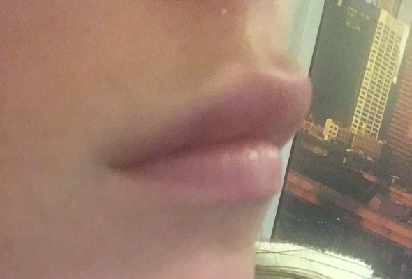 Lippen Aufgespritzt Wie Lange Schwellung Normal Gesundheit Und Medizin Lippen Aufspritzen