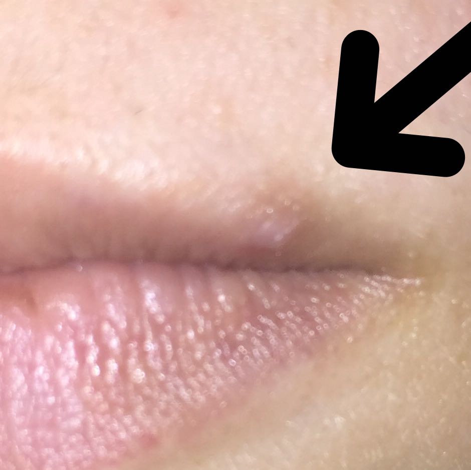 Lippen Aufspritzen Trotz Komisches Teil An Der Lippe Pickel